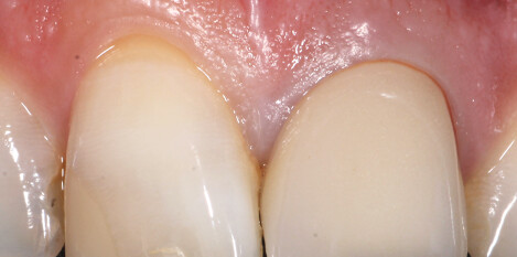 Provisional contour — clinical detail