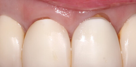 Gingitage: Controlled sulcular invasion during preparation.