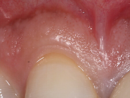 Emergence profile — clinical detail